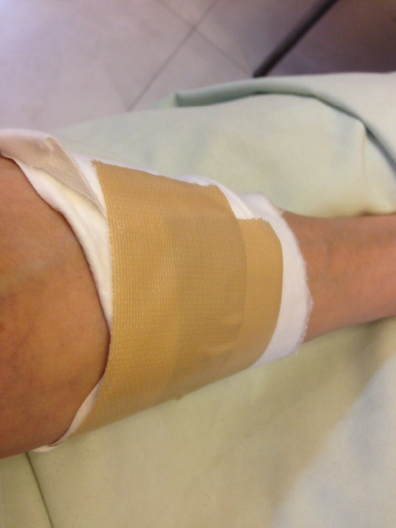 金属アレルギー